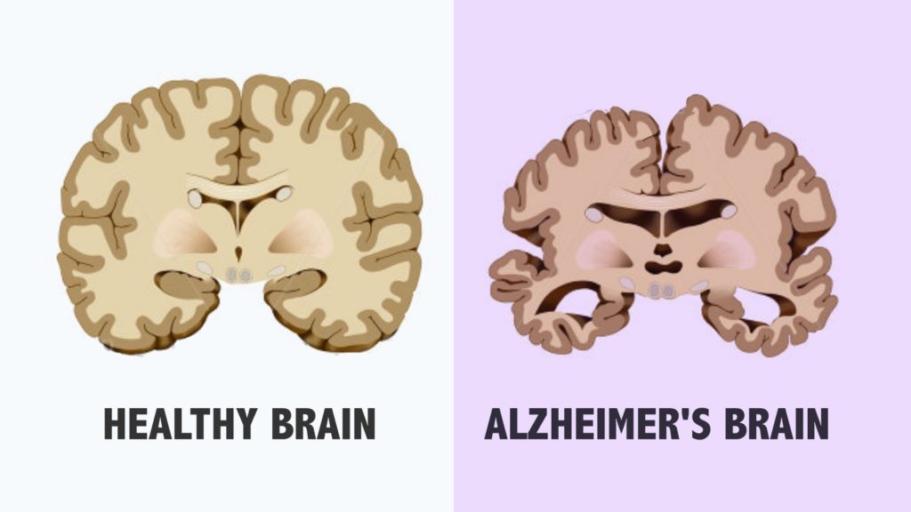 What are the 4 stages of Alzheimer and their effects? CircleCare