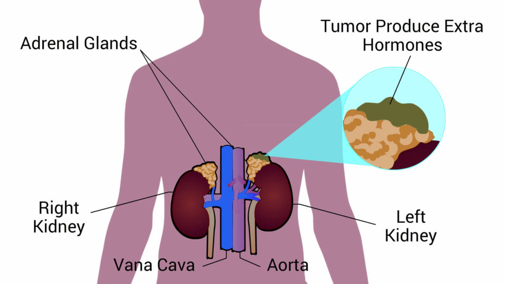 What Are Three Possible Causes Of Hypertension CircleCare