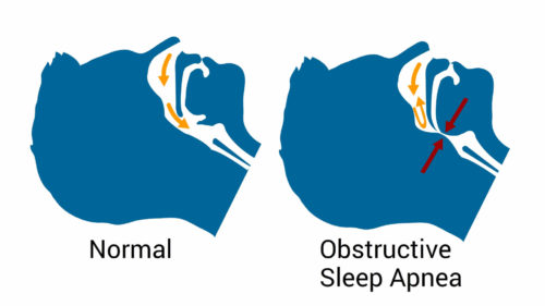 What are three possible causes of hypertension? | CircleCare