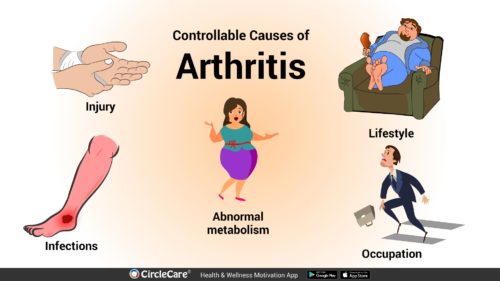 What are the major causes of Arthritis? | CircleCare