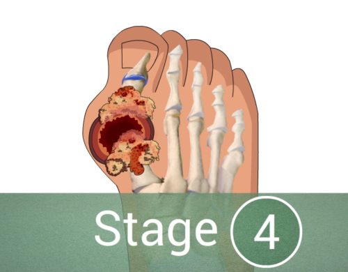 What Are The Stages Of Gout CircleCare