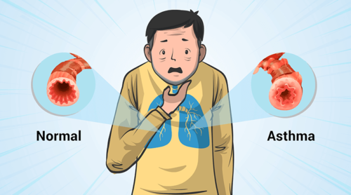 What is Asthma? | Stats,Types, Triggers | CircleCare